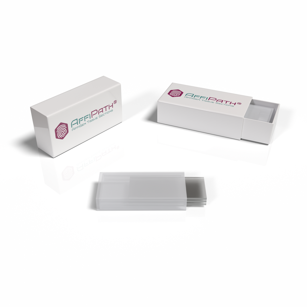 AffiPATH®​ Spleen tumor tissue array with cancer adjacent spleen tissue