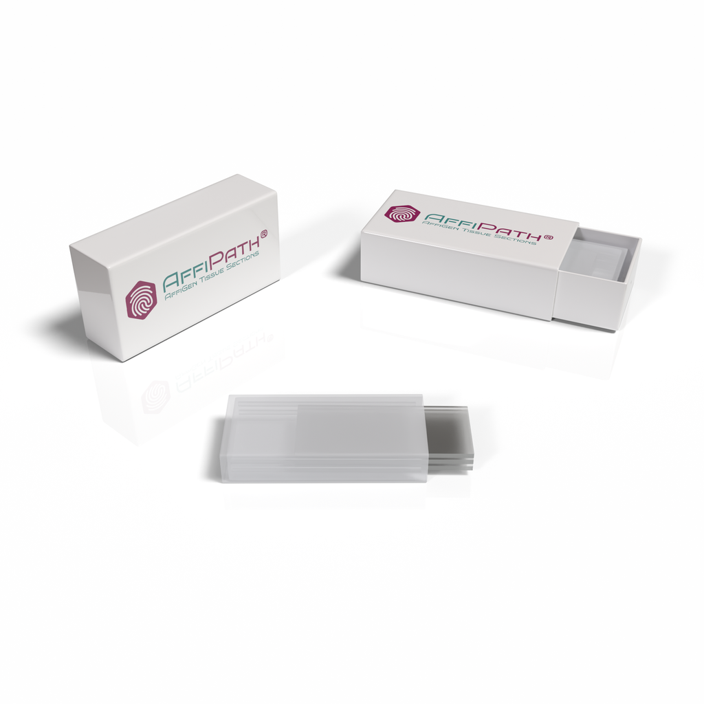 AffiPATH®​ Thymus cancer tissue test array with normal tissue, including pathology grade, TNM and clinical stage replacing T461